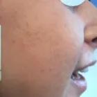 Business 3 image INSTANT LASER CLINIC Tattoo Removal in Kew VIC