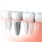 Business 1 image PROSMILES - DENTAL IMPLANTS Dentist in Collingwood VIC
