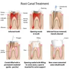 Business 1 image ROOT CANAL MELBOURNE | ROOT CANAL THERAPY PRAHRAN, SOUTH YARRA & WINDSOR Dentist in Melbourne VIC