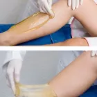 Business 1 image SKIN NEXUS - THE HAIR REMOVAL & BEAUTY SALON Sugaring Hair Removal in Glen Waverley VIC