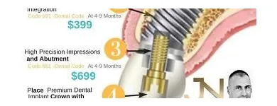 Business 3 image DENTAL IMPLANT PLACEMENTS PERTH tooth screw in Perth WA