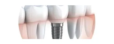 Business 1 image DR PAULO PINHO Wisdom Teeth Removal Cost in Sydney NSW