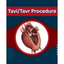 TRANSCATHETER AORTIC VALVE REPLACEMENT (TAVR) COST INDIA Hospital in Perth WA